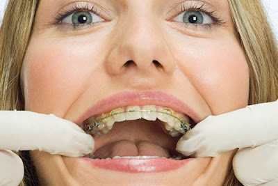 Có nên niềng răng người lớn?