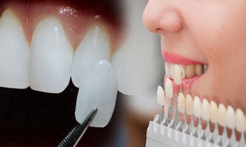 Miếng gián veneer làm tăng giá trị thẩm mỹ và giúp bảo vệ răng đến mức tối đa