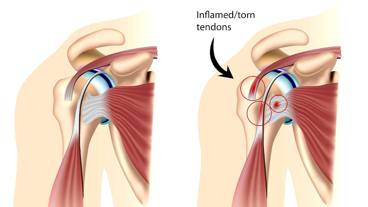 How To Heal A Shoulder Injury