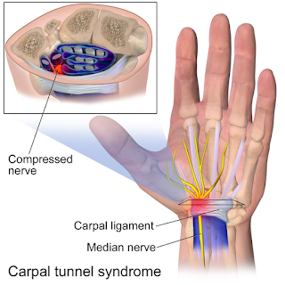 Carpal Tunnel Syndrome