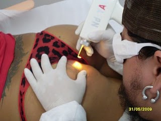 Does Laser Tattoo Removal Hurt