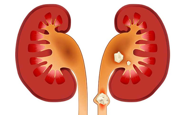 kidney stone information