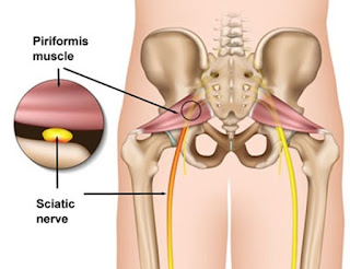 Often mistaken for the same thing, both Piriformis and Sciatic Nerve pain can benefit from from physical therapy.