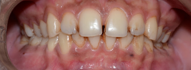 Before Treatment of Space Between Front Teeth