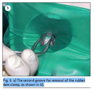 Fig. 5  a) The second groove for removal of the rubber dam clamp, as shown in b).