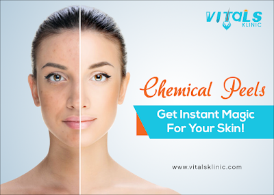 https://www.vitalsklinic.com/chemical-peels