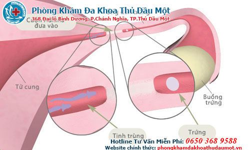 Những biểu hiện của bệnh lậu mãn tính ở nam giới 2