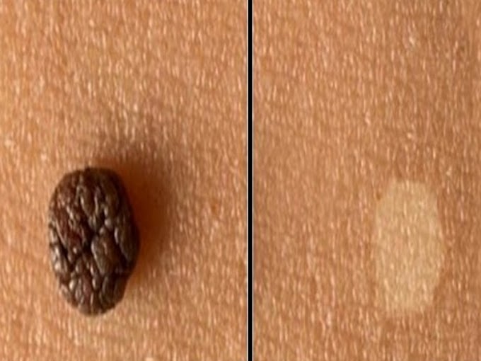 How to Remove a Skin Tag ?