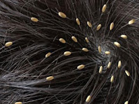 Tips Ampuh!! Cara Menghilangkan Kutu Rambut dan Telurnya Secara Alami