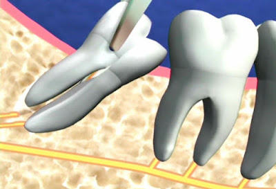 Giải thích tại sao phải nhổ răng khôn khi niềng răng-2