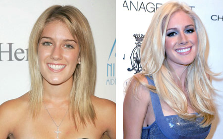 heidi montag before and after people. I think Heidi Montag before