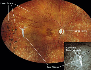 AMD treatment 