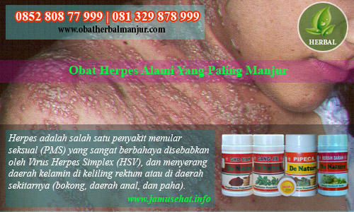 cara menyembuhkan penyakit herpes