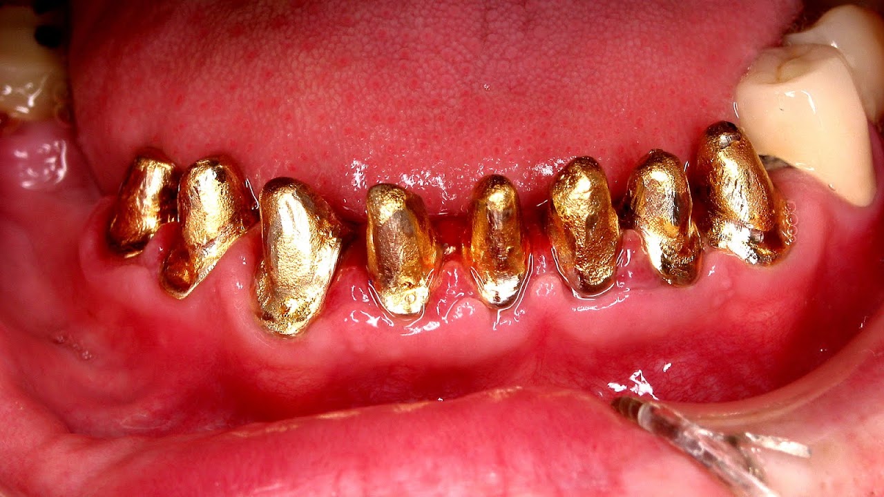 Dental braces - Gold Braces