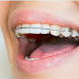 Cách khắc phục răng hàm bị mất như thế nào?