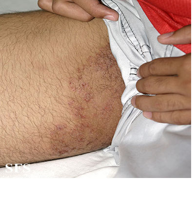 Infections Of The Skin. skin infections called