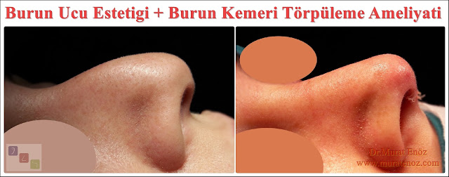 burun ucu estetiği - burun ucu estetiği ameliyatı - burun ucu düzeltme - burun ucu kaldırma - burun ucu ameliyatı - tip plasti kemik kırılmadan burun estetiği - burun kemeri törpüsü - burun törpüleme ameliyatı - burun kemeri törpüleme - burun kemeri törpületme - burun törpüsü - burun kemeri düzeltme - burun törpüleme ameliyatı izle - tip plasty istanbul - nose surgery istanbul - nose tip plasty istanbul - nose tip lifting - tip rhinoplasty in istanbul