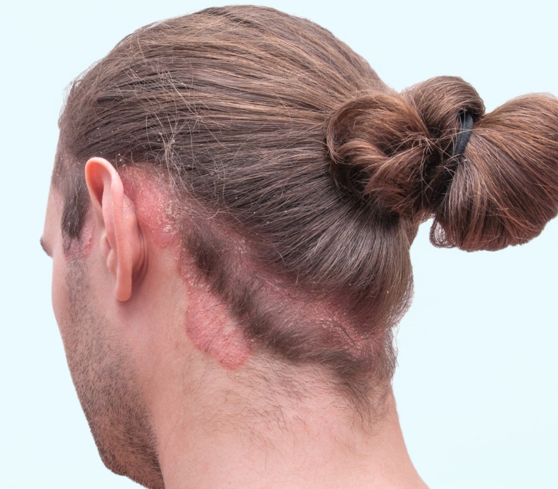 Hair Transplant For Psoriasis Patients