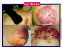 obat alternatif tumor payudara