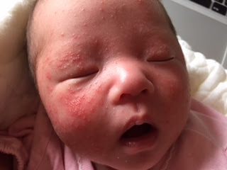 [10000ダウンロード済み√] 赤ちゃん 白いぶつぶつ 176122-赤ちゃん 白いブツブツ