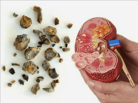 Solusi Sakit Batu disaluran kemih,prostat dan Batu Ginjal menurut Konsep Karnus