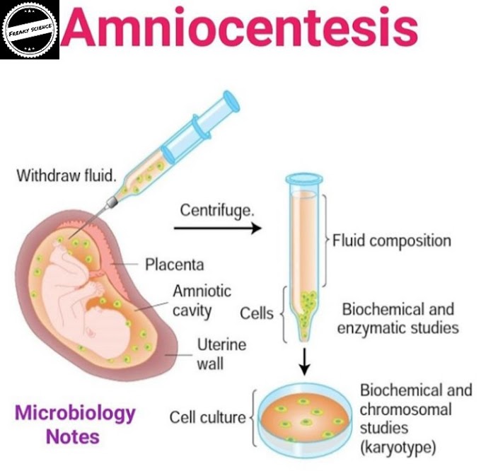 Amniocentesis