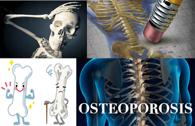 https://natwiki.blogspot.com/2018/06/prevenir-la-osteoporosis-en-3-pasos.html