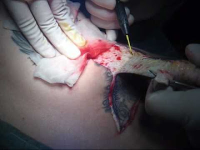 Excision Tattoo removal