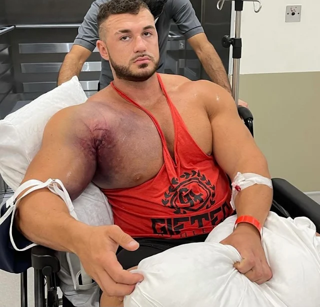 Bodybuilder's Pec Muscle Torn From Bone During 220kg Bench Press