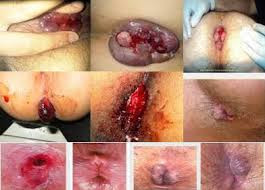 Obat Wasir Herbal Paling Ampuh