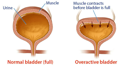 In people with an overactive bladder (OAB), the layered, smooth muscle that surrounds the bladder (detrusor muscle)