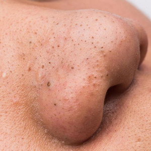 how to get rid of tiny bumps on face quickly