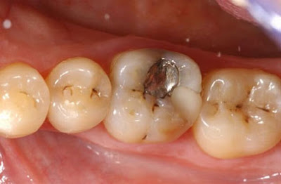 Quy trình chữa bệnh răng sâu được tiến hành như thế nào?