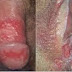 Obat Sipilis Mujarab 3 Hari Sembuh thumbnail