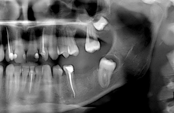 PDF: Mandibular Third Molar Impaction: Review of Literature and a Proposal of a Classification 