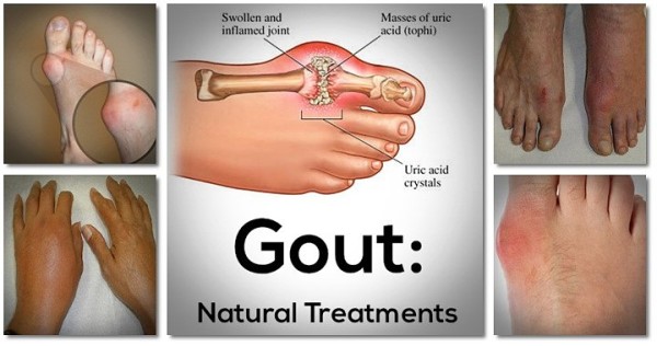 The End of Gout Reviews – Really This Helps You to Fight?