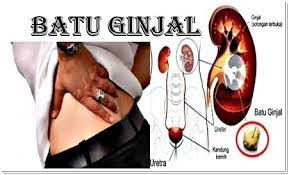 Obat Untuk Mengatasi sakit batu ginjal selain dengan operasi