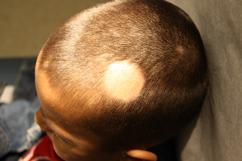 Alopecia areata