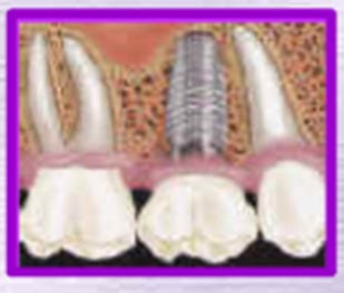 dental implants San Diego