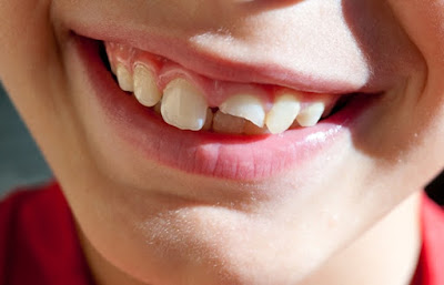 Khi răng bị mẻ nên làm gì?