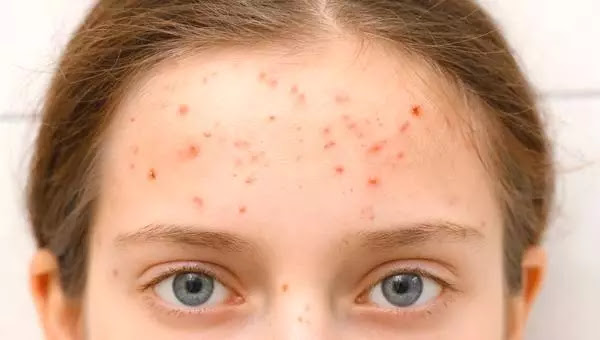 Small bumps on the forehead: causes, treatment, and prevention.