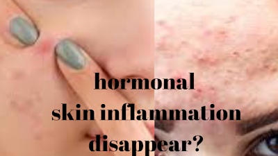 Does grown-up hormonal  skin inflammation  disappear?