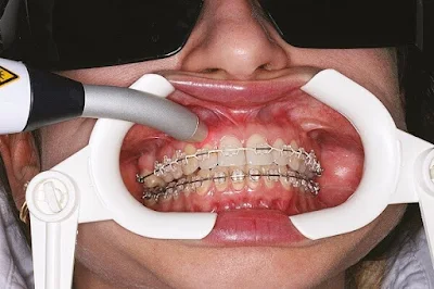 Tại sao phải thay dây cung trong niềng răng chỉnh nha?-3