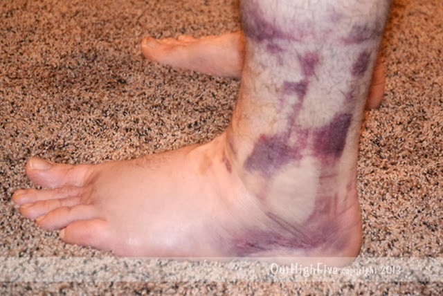 07-2013-Sprained-ankle-2