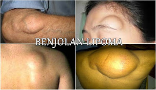 Cara Menghilangkan Lipoma Di Dahi