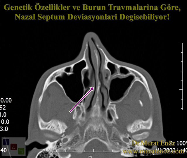 Nazal Septum Deviasyonu  Çeşitleri - Nazal Septum Deviasyonu  Animasyonu - Kaudal Septum Deviasyonu - Anterior Septal Dislokasyon - Kaudal Septoplasti - Kaudal Septum Deviasyonu Tedavisi - Septal Spur Formasyonu - Nazal Septal Spur - Burunda Kemik Spur - Septal Spur Belirtileri - Septal Spur Tedavisi - Nazal Septum Deviasyonu  Tedavisi - Deviasyon Ameliyatı Nasıl Yapılır? - Septoplasti Ameliyatı - SMR Ameliyatı