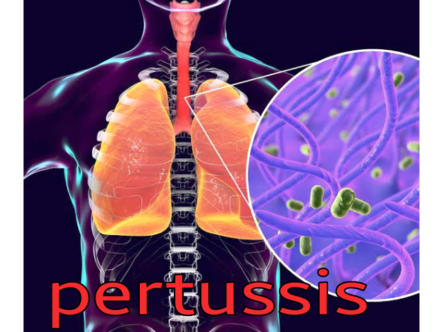 Pertussis disease diagram, pertussis image