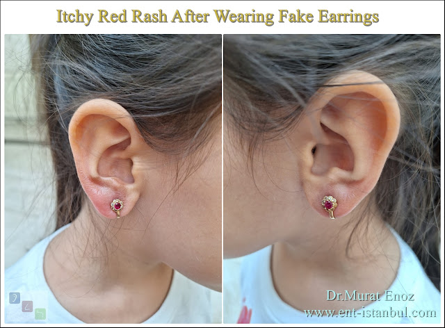 Fake Jewelry Allergies, Imitation Earring Allergy, Fake Jewelry Rash on Ear?, Can Artificial Jewelry Cause Infections?,  Itchy Red Rash After Wearing Fake Earrings