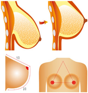 lifting augmentation mammaire