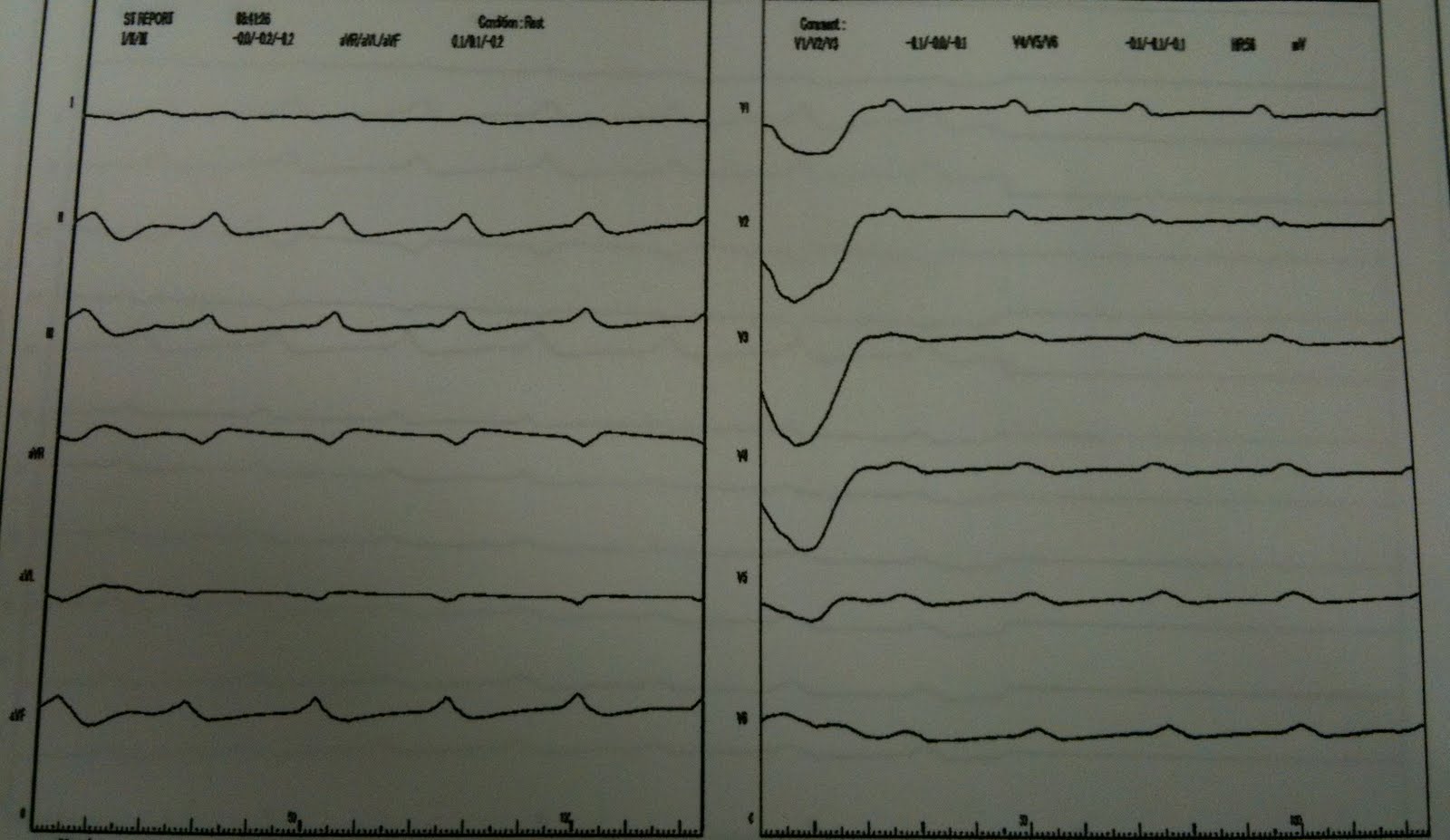 J Balloon Acls Bls Cardiology 気分不良の心電図